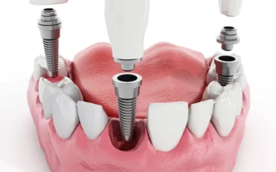 5 Reasons You May Need Dental Bone Grafting