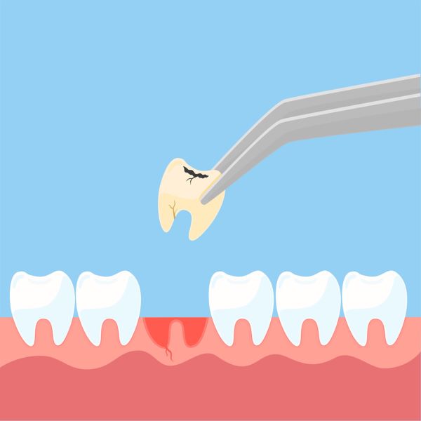 Dentist in Fairfield, Connecticut, Explains Simple and Surgical Tooth Extractions
