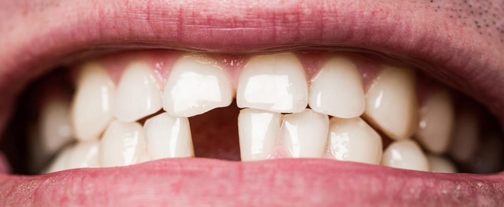 Embracing the Unexpected: Overcoming Embarrassment About Losing Teeth